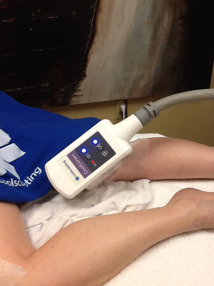 Coolsculpting on an inner thigh.