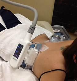 Dual CoolSculpting Treatment in Process