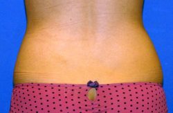 CoolSculpting