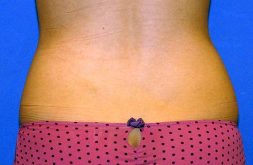 CoolSculpting