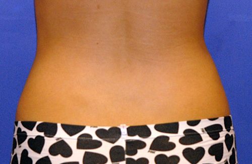 CoolSculpting