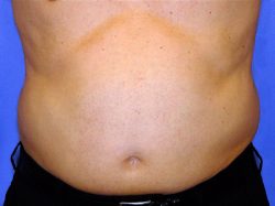 CoolSculpting