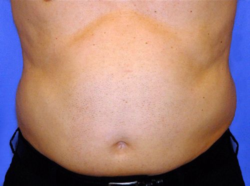 CoolSculpting