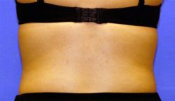 CoolSculpting