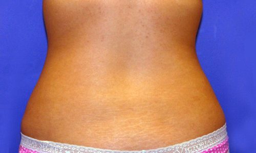 CoolSculpting