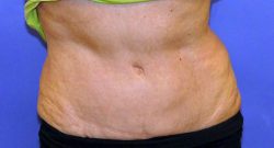 CoolSculpting