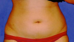 CoolSculpting