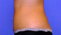 CoolSculpting