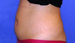 CoolSculpting