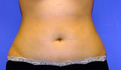 CoolSculpting