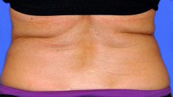 CoolSculpting