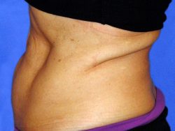 CoolSculpting