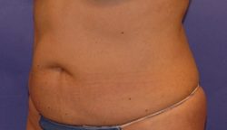 CoolSculpting