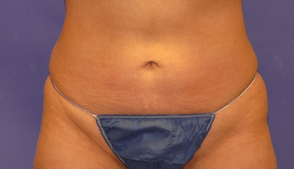 CoolSculpting