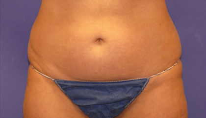 CoolSculpting