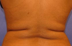 CoolSculpting