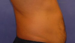 CoolSculpting