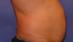 CoolSculpting