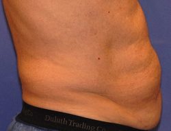 CoolSculpting