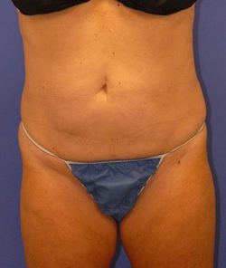 CoolSculpting