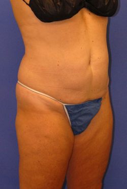 CoolSculpting