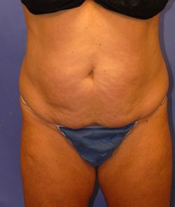 CoolSculpting