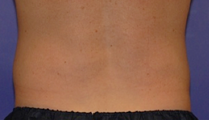 CoolSculpting