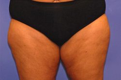 CoolSculpting