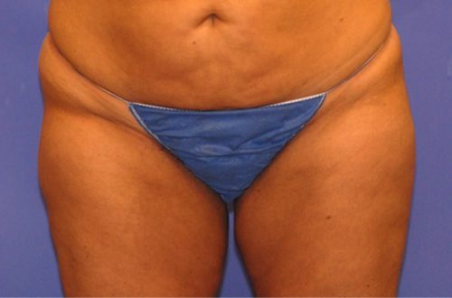 CoolSculpting