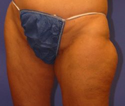 CoolSculpting