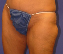 CoolSculpting