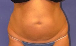 CoolSculpting