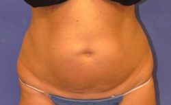 CoolSculpting