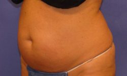 CoolSculpting