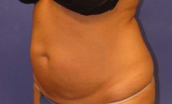 CoolSculpting