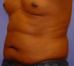 CoolSculpting