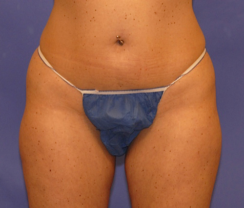 CoolSculpting