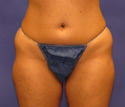 CoolSculpting