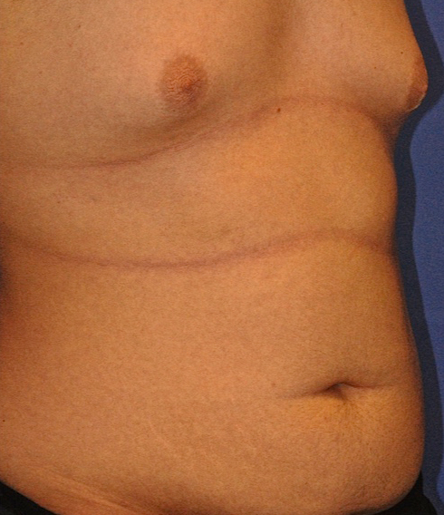 CoolSculpting