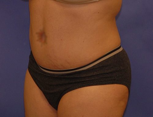 CoolSculpting