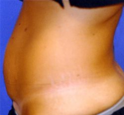 CoolSculpting