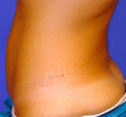 CoolSculpting