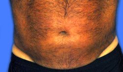 CoolSculpting