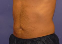 CoolSculpting