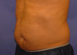 CoolSculpting