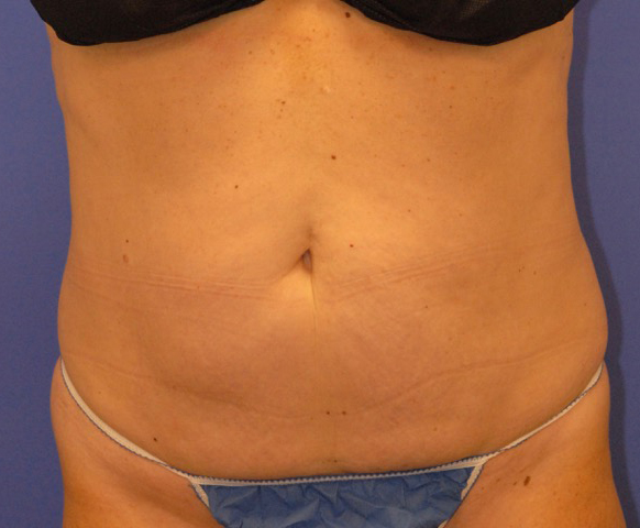 CoolSculpting