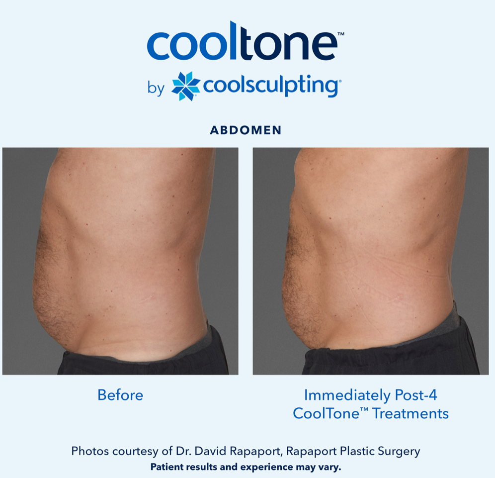 CoolTone Before & After Results