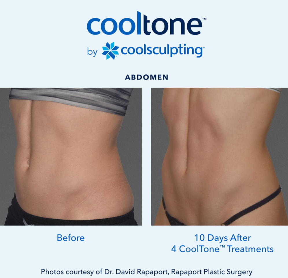 CoolTone Before & After Results