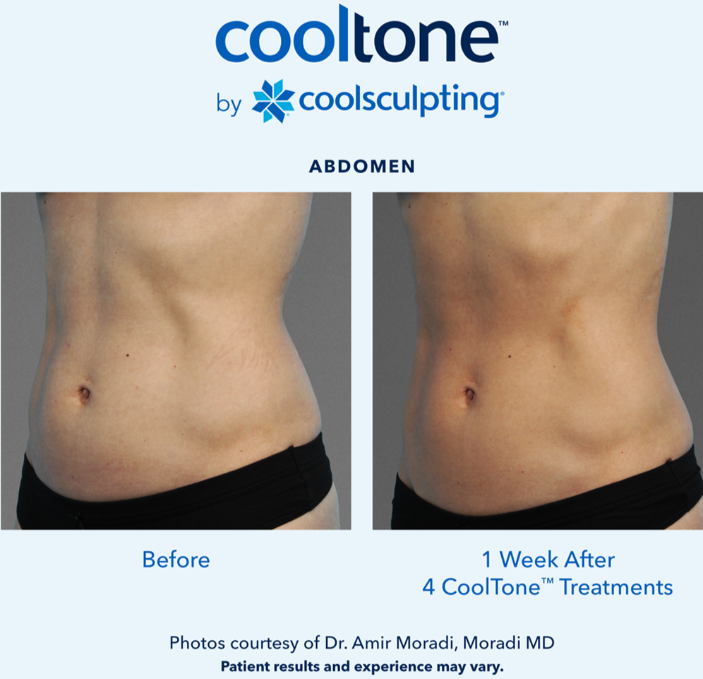 CoolTone Before & After Results