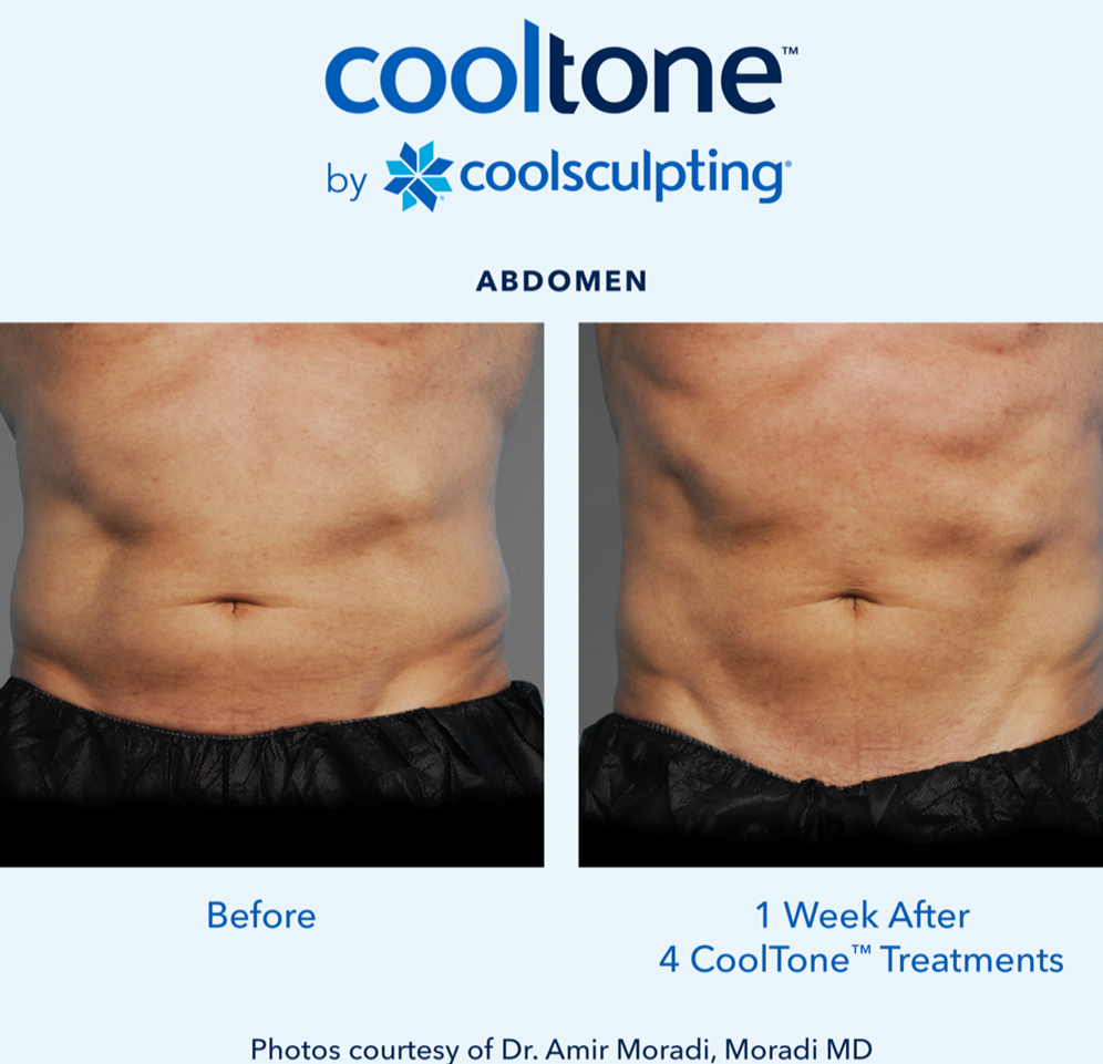 CoolTone Before & After Results